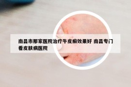 南昌市那家醫(yī)院治療牛皮癬效果好 南昌專門看皮膚病醫(yī)院