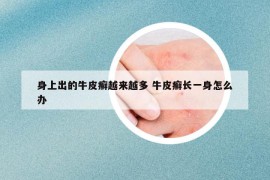 身上出的牛皮癬越來越多 牛皮癬長一身怎么辦