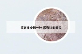 拓咨多少錢一針 拓咨注射部位