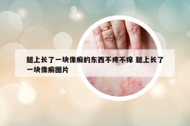 腿上長了一塊像癬的東西不疼不癢 腿上長了一塊像癬圖片