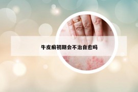 牛皮癬初期會不治自愈嗎