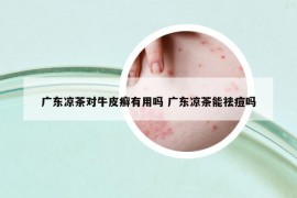 廣東涼茶對牛皮癬有用嗎 廣東涼茶能祛痘嗎