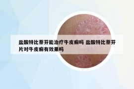 鹽酸特比萘芬能治療牛皮癬嗎 鹽酸特比萘芬片對牛皮癬有效果嗎