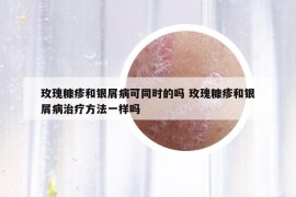 玫瑰糠疹和銀屑病可同時(shí)的嗎 玫瑰糠疹和銀屑病治療方法一樣嗎