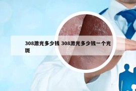 308激光多少錢 308激光多少錢一個光斑