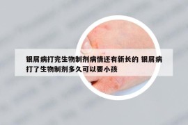 銀屑病打完生物制劑病情還有新長的 銀屑病打了生物制劑多久可以要小孩