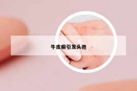 牛皮癬引發(fā)頭孢