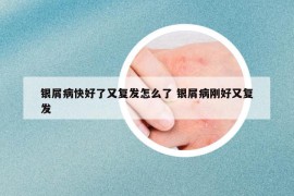 銀屑病快好了又復發(fā)怎么了 銀屑病剛好又復發(fā)