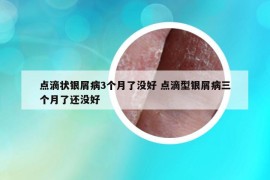 點(diǎn)滴狀銀屑病3個(gè)月了沒(méi)好 點(diǎn)滴型銀屑病三個(gè)月了還沒(méi)好