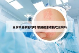 豆腐銀屑病能吃嗎 銀屑病患者能吃豆腐嗎