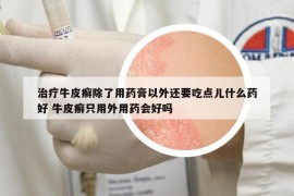 治療牛皮癬除了用藥膏以外還要吃點(diǎn)兒什么藥好 牛皮癬只用外用藥會好嗎