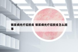 銀屑病光療后脫皮 銀屑病光療后脫皮怎么回事
