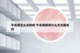 牛皮癬怎么去除癢 牛皮癬癢用什么方法最有效