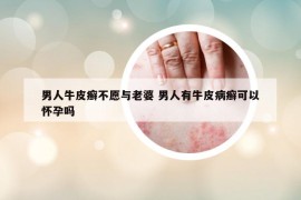 男人牛皮癬不愿與老婆 男人有牛皮病癬可以懷孕嗎