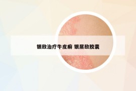 銀敵治療牛皮癬 銀屑敵膠囊