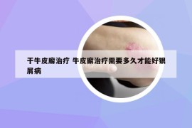 干牛皮廨治療 牛皮廨治療需要多久才能好銀屑病