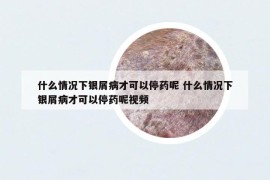 什么情況下銀屑病才可以停藥呢 什么情況下銀屑病才可以停藥呢視頻