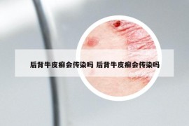 后背牛皮癬會傳染嗎 后背牛皮癬會傳染嗎