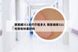 銀屑病311光療療程多久 銀屑病用311光照射效果好嗎