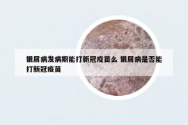 銀屑病發(fā)病期能打新冠疫苗么 銀屑病是否能打新冠疫苗
