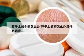 脖子上長個癬怎么辦 脖子上長癬怎么辦用什么藥膏