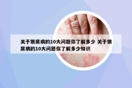 關(guān)于銀屑病的10大問(wèn)題你了解多少 關(guān)于銀屑病的10大問(wèn)題你了解多少知識(shí)