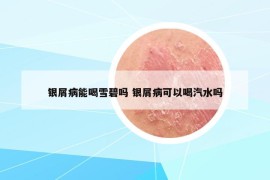 銀屑病能喝雪碧嗎 銀屑病可以喝汽水嗎