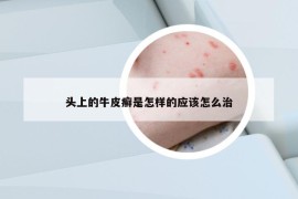 頭上的牛皮癬是怎樣的應(yīng)該怎么治
