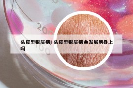 頭皮型銀屑病j 頭皮型銀屑病會(huì)發(fā)展到身上嗎