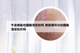 牛皮癬能吃醋酸潑尼松嗎 銀屑病可以吃醋酸潑尼松片嗎