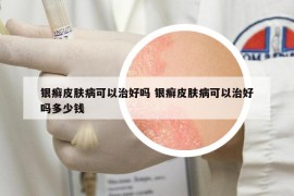 銀癬皮膚病可以治好嗎 銀癬皮膚病可以治好嗎多少錢(qián)