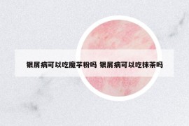 銀屑病可以吃魔芋粉嗎 銀屑病可以吃抹茶嗎