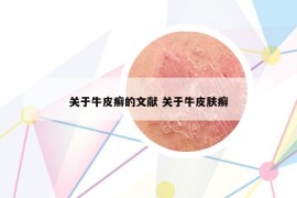 關(guān)于牛皮癬的文獻(xiàn) 關(guān)于牛皮膚癬