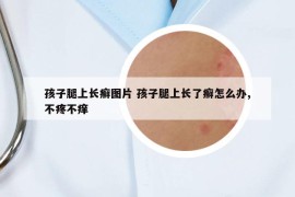 孩子腿上長癬圖片 孩子腿上長了癬怎么辦,不疼不癢