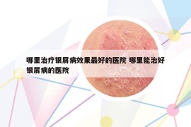 哪里治療銀屑病效果最好的醫(yī)院 哪里能治好銀屑病的醫(yī)院