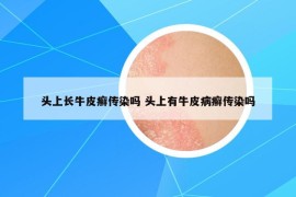 頭上長(zhǎng)牛皮癬傳染嗎 頭上有牛皮病癬傳染嗎