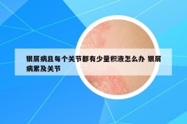 銀屑病且每個關節(jié)都有少量積液怎么辦 銀屑病累及關節(jié)