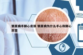 銀屑病手腳心皮損 銀屑病為什么手心和腳心厲害