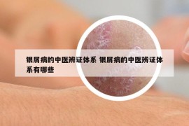 銀屑病的中醫(yī)辨證體系 銀屑病的中醫(yī)辨證體系有哪些