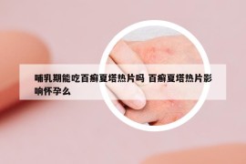 哺乳期能吃百癬夏塔熱片嗎 百癬夏塔熱片影響懷孕么