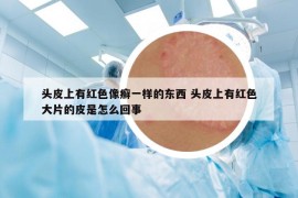 頭皮上有紅色像癬一樣的東西 頭皮上有紅色大片的皮是怎么回事