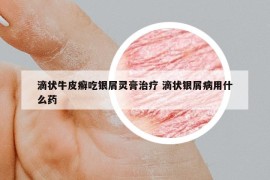 滴狀牛皮癬吃銀屑靈膏治療 滴狀銀屑病用什么藥