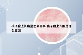 孩子臉上長癬是怎么回事 孩子臉上長癬是什么原因