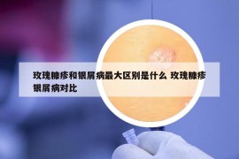 玫瑰糠疹和銀屑病最大區(qū)別是什么 玫瑰糠疹銀屑病對比