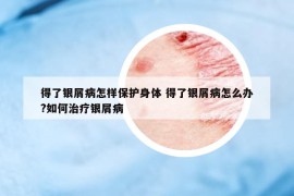 得了銀屑病怎樣保護(hù)身體 得了銀屑病怎么辦?如何治療銀屑病