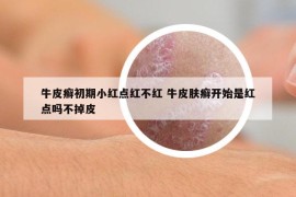 牛皮癬初期小紅點(diǎn)紅不紅 牛皮膚癬開(kāi)始是紅點(diǎn)嗎不掉皮