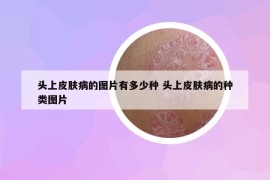 頭上皮膚病的圖片有多少種 頭上皮膚病的種類圖片