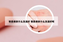銀屑病拿什么洗澡好 銀屑病拿什么洗澡好呢