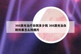 308激光治療白斑多少錢 308激光治白斑效果怎么樣圖片