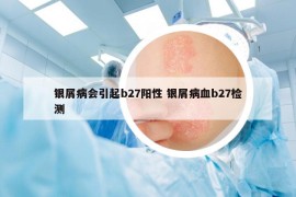 銀屑病會(huì)引起b27陽性 銀屑病血b27檢測